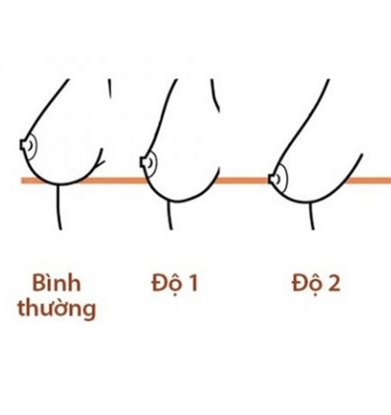 Sa trễ cấp độ 1, cấp độ 2