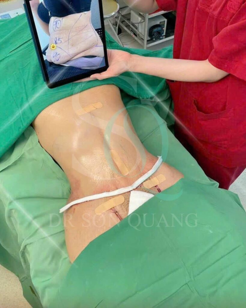 Ca hút mỡ bụng Dr Quang