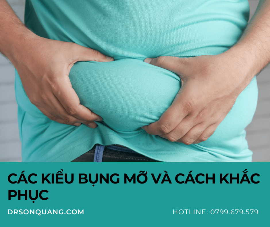 Các kiểu bụng mỡ và cách khắc phục