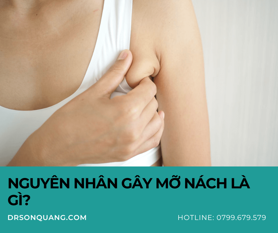 Nguyên nhân gây Mỡ nách là gì?