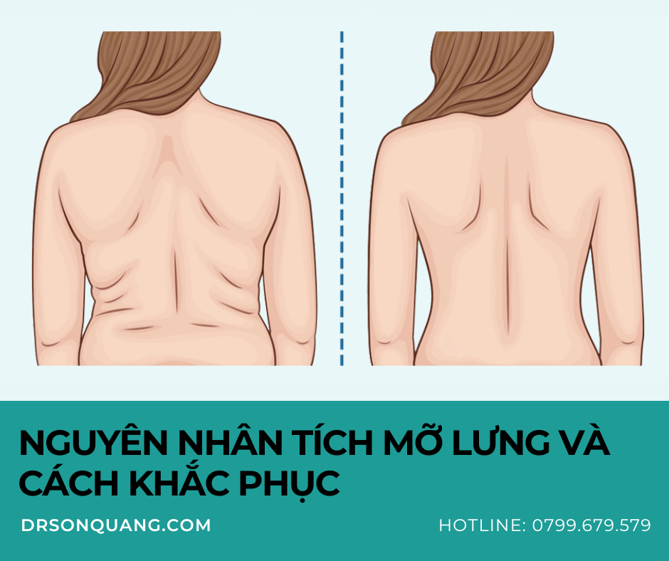 Nguyên nhân tích mỡ lưng