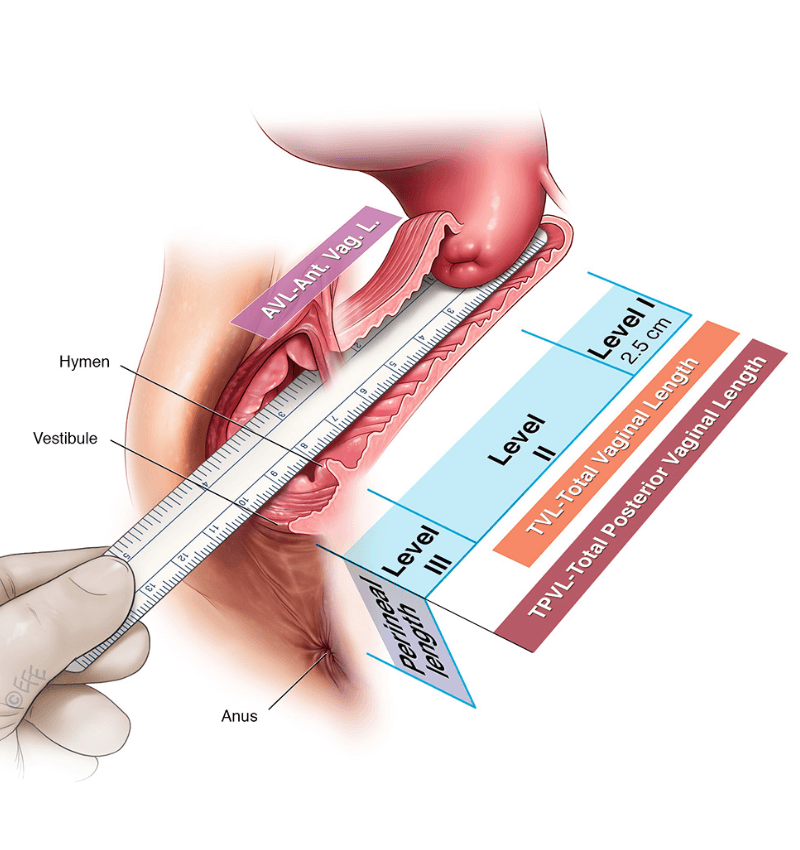 Độ Sâu của Âm Đạo