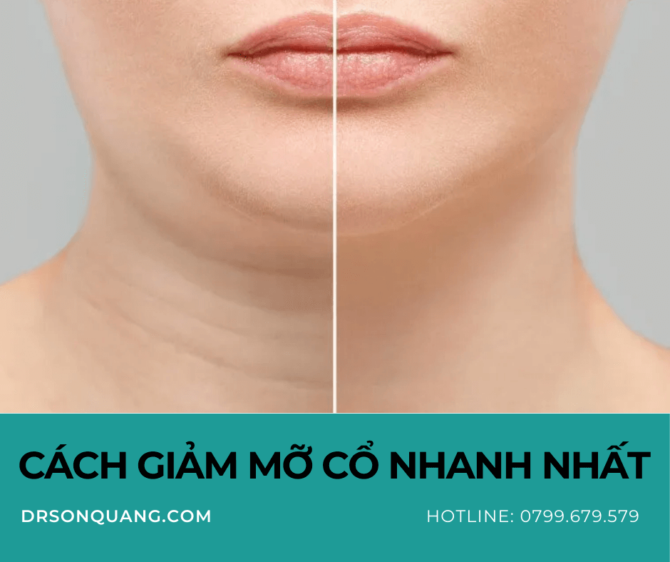 Cách giảm mỡ cổ nhanh nhất: Bí quyết sở hữu chiếc cổ thon gọn, quyến rũ